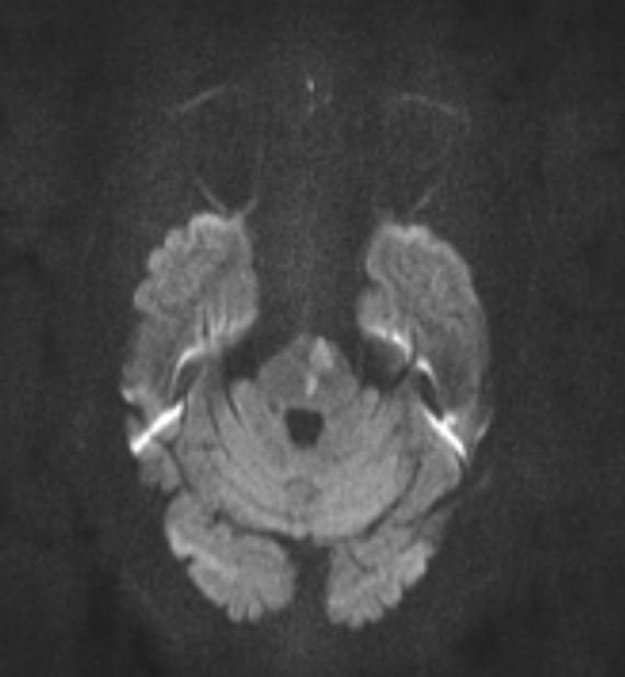 INFARCT